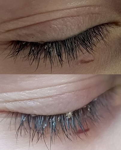 Figura 1. Perlas ovaladas, marronáceas y brillantes junto con piojo maduro adheridos a las pestañas del párpado superior del ojo derecho.