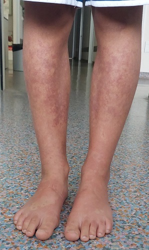 Figura 1. Lesiones equimóticas coalescentes en extremidades inferiores