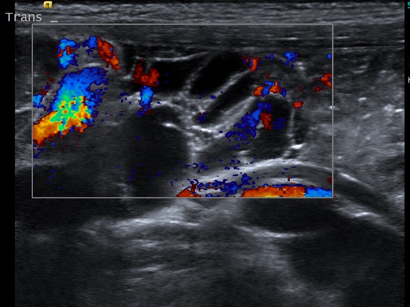 Figura 1. Ecografía abdominal con estructura quística, poliseptada en línea media por debajo del ombligo de 3,5 x 1,9 x 3 cm con vascularización presente en pared orientada como malformación linfática abdominal