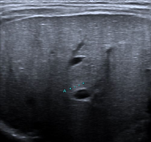Figura 1. Signo del cordón triangular: hallazgo sugestivo de AVB