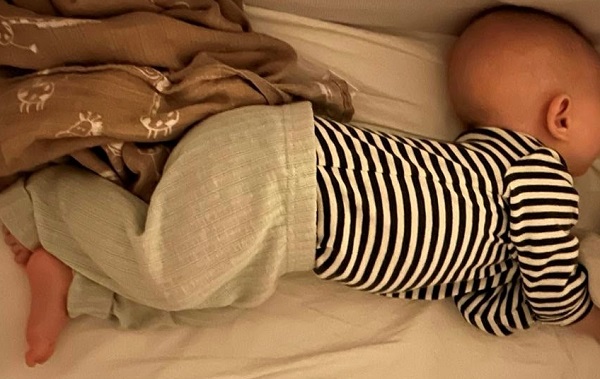 Figura 1. Imagen ilustrativa del arqueo postural característico del SS