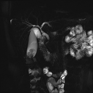 Figura 1. Ecografía abdominal en la que se objetiva colelitiasis