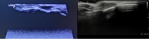 Figura 1A (izda.). Ecografía en el centro de centro de salud. Figura 1B (dcha.). Ecografía en el Servicio de Radiología del hospital de referencia.