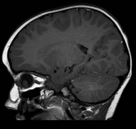 Figura 1. Ecografía ocular