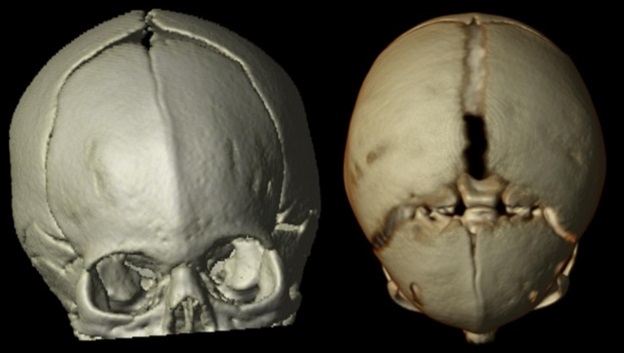 Figura 1. Tomografía axial computarizada craneal. Cierre parcial de la sutura metópica