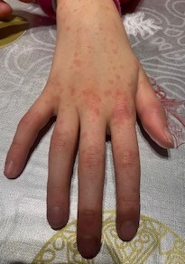 Figura 1. Exantema de mano de la paciente durante su ingreso