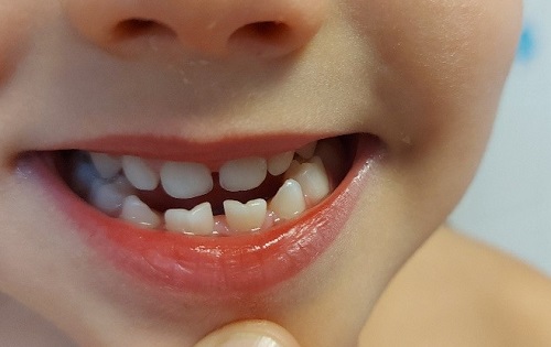 Figura 1. Fusión de los incisivos inferiores