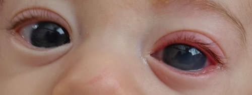 Figura 1. Alteraciones oculares