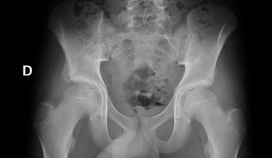 Figura 1. Radiografía simple anteroposterior de pelvis