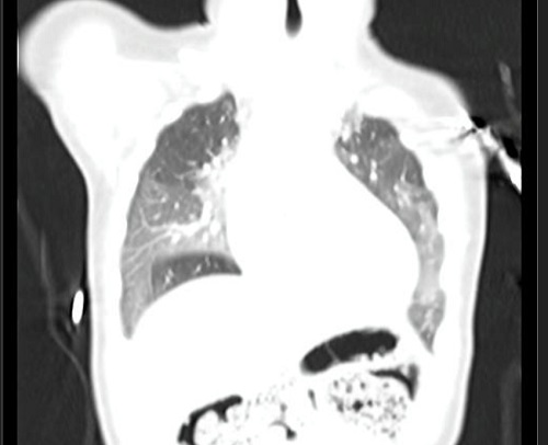 Figura 2. Opacidades en vidrio esmerilado en TAC pulmonar