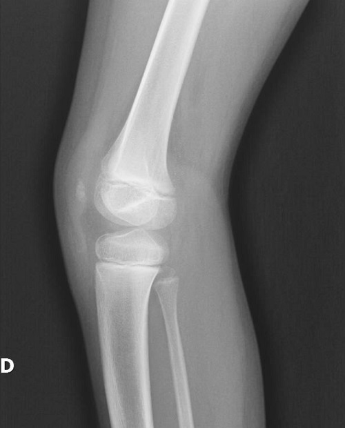 Figura 1. Radiografía lateral de la rodilla derecha 