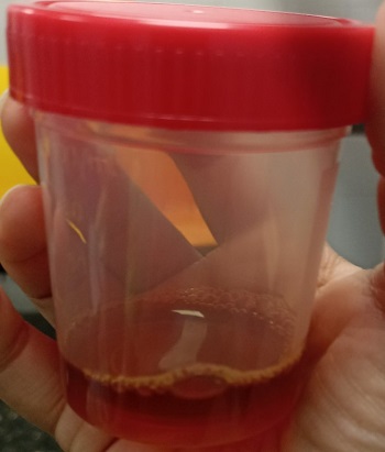 Figura 1. Muestra de orina del paciente donde se objetiva coluria