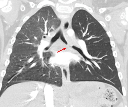 Figura 2. Corte coronal TAC tórax