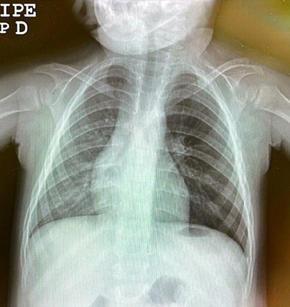 Figura 1. Radiografía de tórax