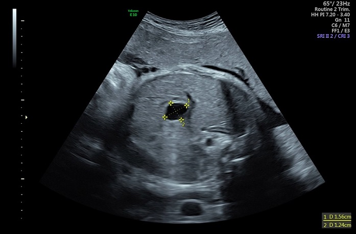 Figura 1. Quiste hepático congénito. Ecografía prenatal en la que se visualiza una imagen quística abdominal