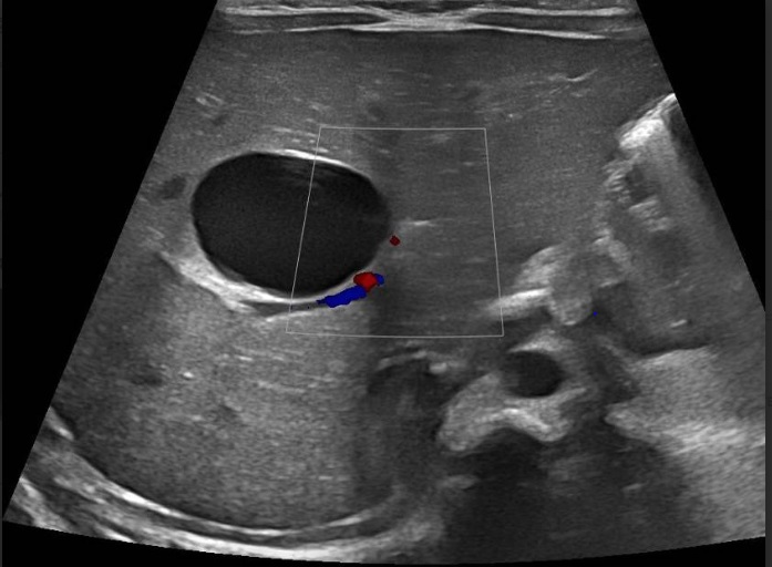 Figura 2. Quiste hepático congénito. Quiste simple unilocular de pared fina en el interior del lóbulo hepático derecho, de 25 x 17 mm (ejes transverso y anteroposterior), en segmento IV. No se demuestra comunicación con la vesícula biliar ni con la vía biliar