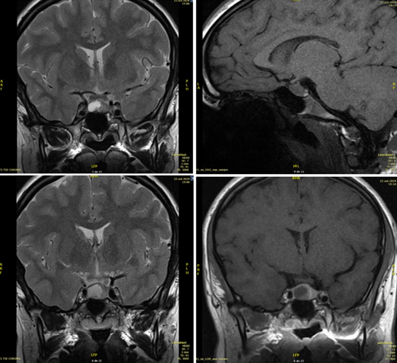 Figura 1. Lesión redondeada en margen derecho de la adenohipófisis (isointensa T1, hiperintensa T2), hipocaptante con realce tardío