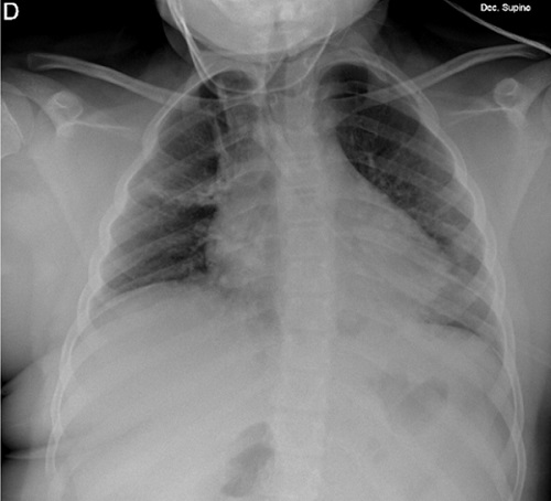 Figura 1. Radiografía de tórax donde se observan atelectasias subsegmentarias en lóbulo superior derecho y consolidación parenquimatosa en lóbulo inferior izquierdo