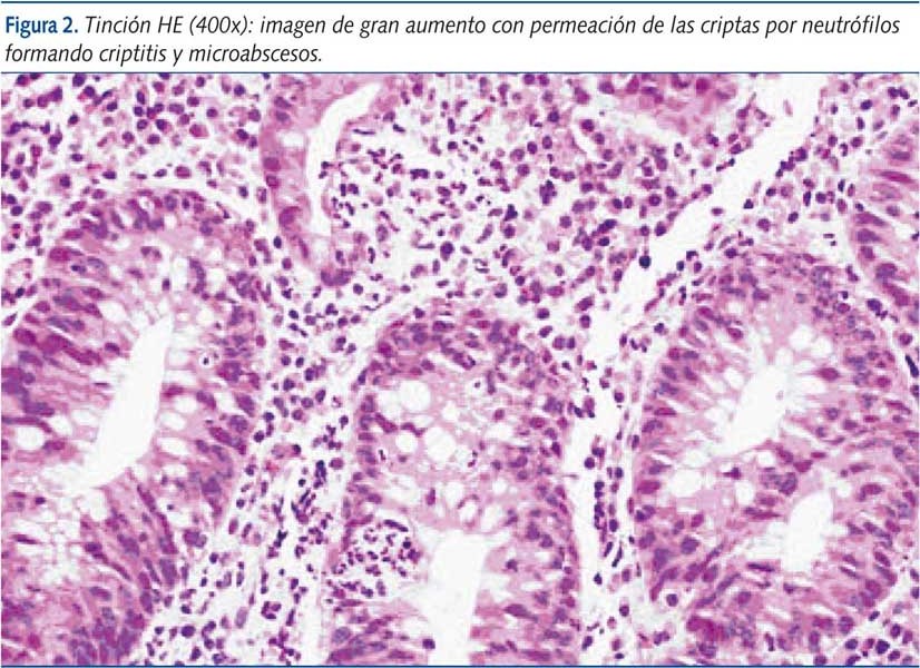 Figura 2. Tinción HE (400x): imagen de gran aumento con permeación de las criptas por neutrófilos formando criptitis y microabscesos.