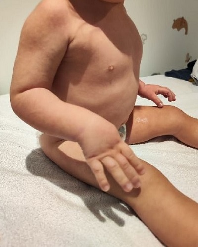 Figura 1. Metacarpo estrecho. 5.º metacarpiano normal