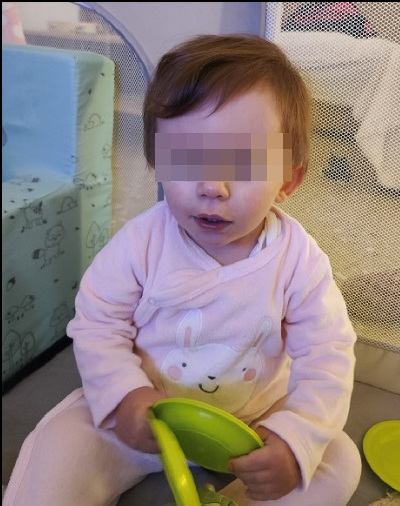 Figura 2. Megacefalia relativa, filtrum amplio, nariz bulbosa