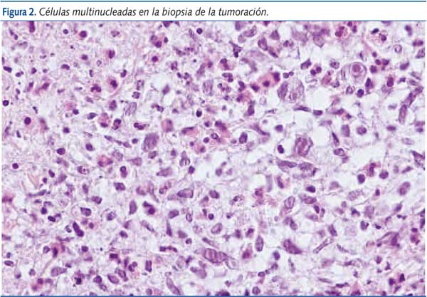 Figura 2. Células multinucleadas en la biopsia de la tumoración.