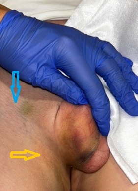 Figura 1. Progresión del hematoma hacia la región de teste derecho