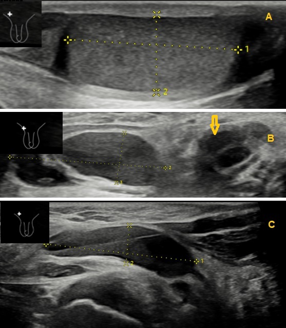 Figura 2. Imágenes de la lesión linfática en la ecografía inguinal realizada en urgencias