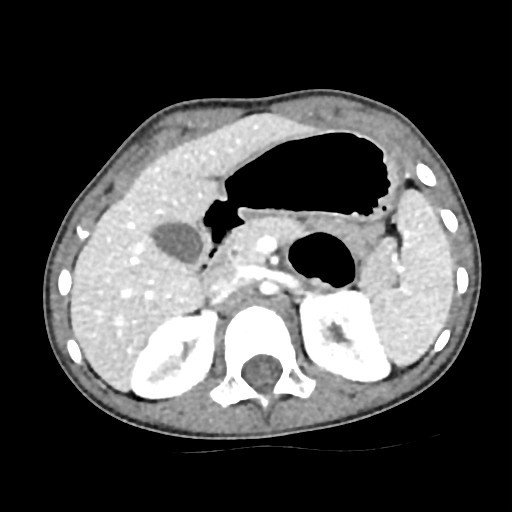 Figura 2. TC abdominal. Atrapamiento duodenal con dilatación proximal. La brida no se visualiza como tal, pero sí su efecto compresivo.
