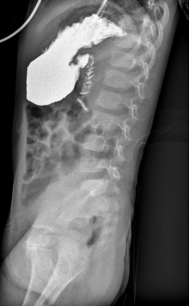Figura 1. Tránsito digestivo superior. Se visualiza un stop a la progresión del contraste a partir del ángulo de Treitz. Dilatación del territorio proximal al stop.