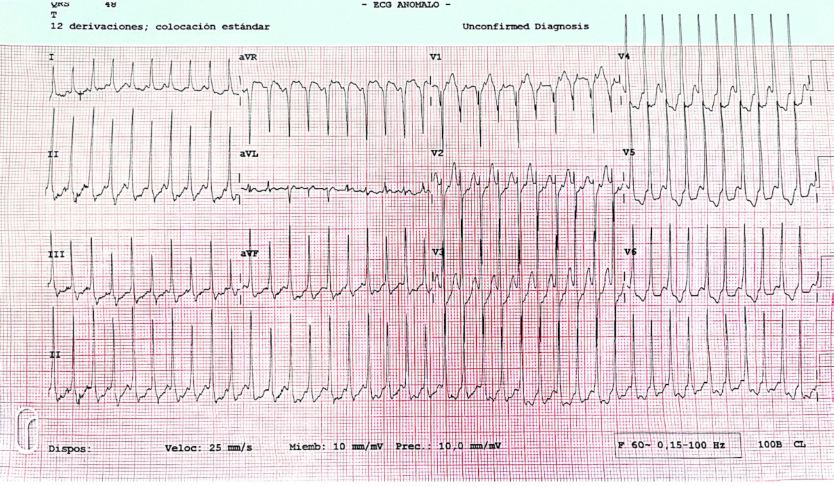 Figura 1. ECG de 12 derivaciones durante episodio de taquicardia regular de QRS estrecho a 240-260 lpm, compatible con taquicardia por reentrada auriculoventricular ortodrómica.