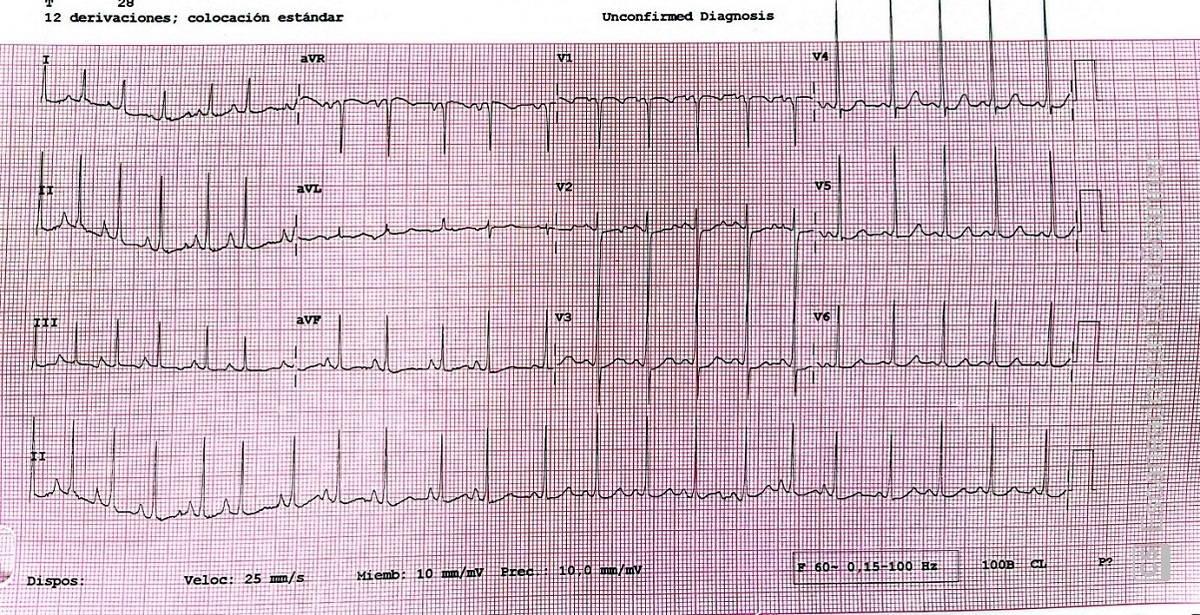 Figura 2. ECG basal en ritmo sinusal con signos de preexcitación ventricular (onda delta y PR corto) compatibles
con síndrome de Wolff-Parkinson-White