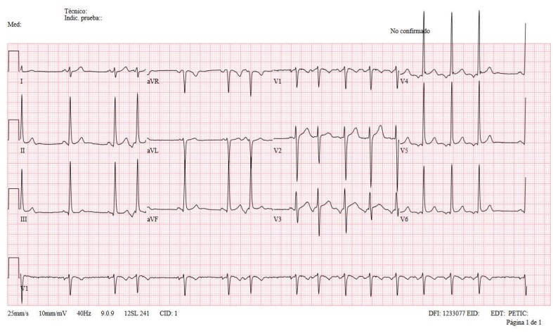 Figura 2. Ritmo sinusal. Electrocardiograma con rachas de taquicardia auricular ectópica y ritmo sinusal