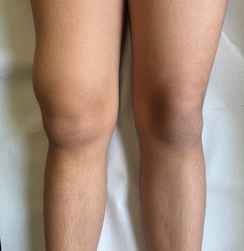 Figura 1. Sinovitis villonodular pigmentada. Tumefacción a nivel suprapatelar de la rodilla derecha