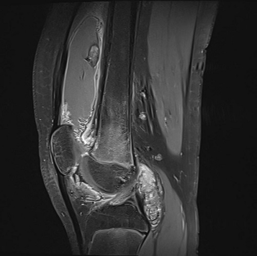 Figura 2. Sinovitis villonodular pigmentada
