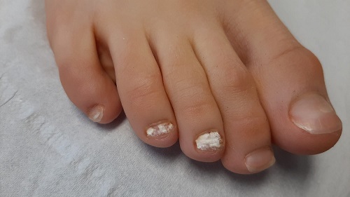 Figura 1. Lesiones blanquecinas y opacas, de aspecto similar a tiza, en la porción dorsal de la placa ungueal. 