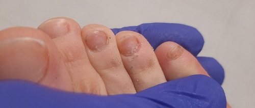 Figura 2. Visible mejoría de las lesiones blanquecinas y opacas, aunque con persistencia de restos de las mismas en las placas ungueales de los dedos tercero, cuarto y quinto.