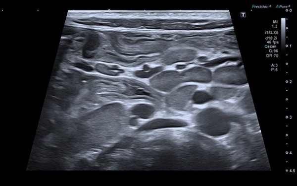 Figura 1. Paciente de 8 años. Crisis celíaca. Ecografía abdominal: engrosamiento difuso de asas intestinales y numerosas adenopatías, de carácter reactivo.