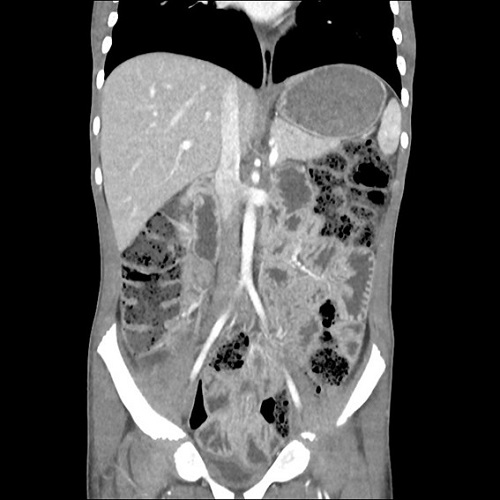 Figura 2. Paciente de 8 años. Crisis celíaca. TC abdominal: engrosamiento difuso e inespecífico de asas intestinales, sin datos de obstrucción/estenosis.