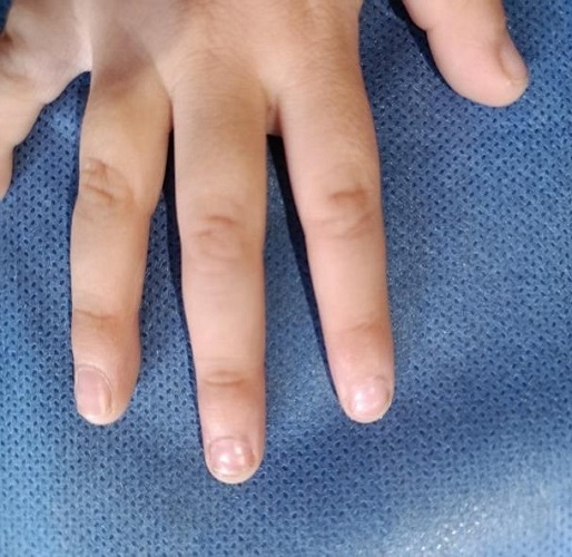 Figura 1. Desprendimiento proximal de la lámina ungueal en tercer y cuarto dedo de la mano izquierda, compatible con onicomadesis