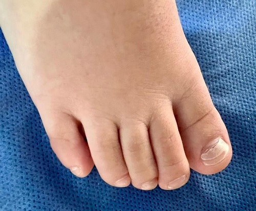 Figura 2. Onicomadesis del primer dedo del pie derecho, con desprendimiento completo de la lámina ungueal