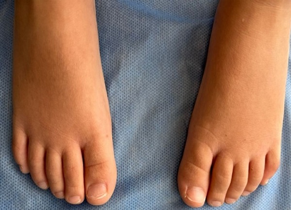 Figura 3. Onicomadesis del primer dedo del pie derecho, con regeneración de la lámina ungueal