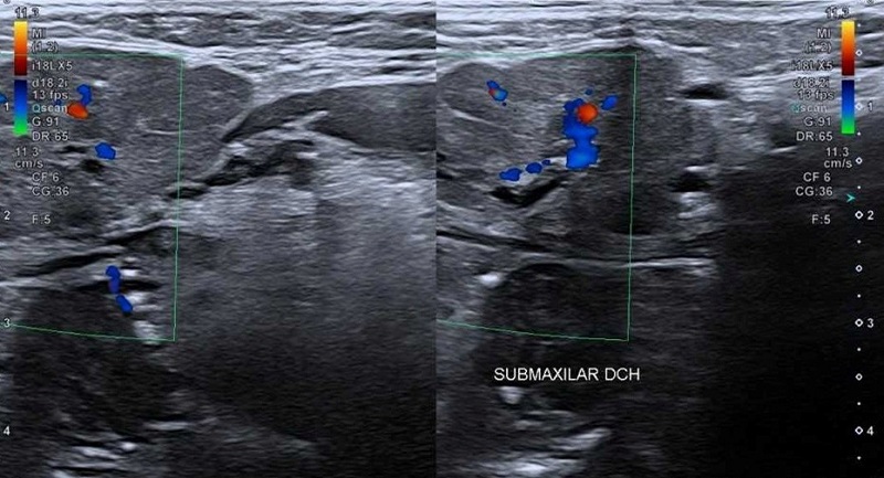 Figura 2. Submaxilitis derecha