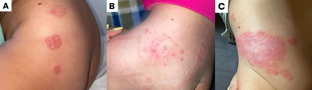 Figura 1. Evolución clínica de la lesión. 