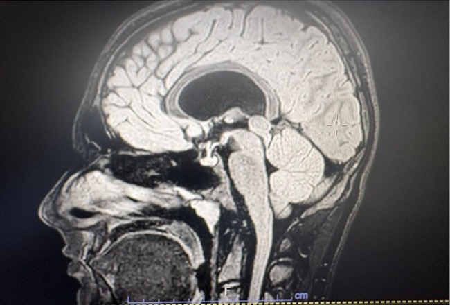 Figura 1. RMN con evidencia de un quiste pineal.