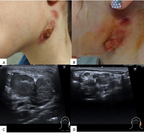 Figura 1. Linfadenitis submandibular izquierda con masa violácea excrecente