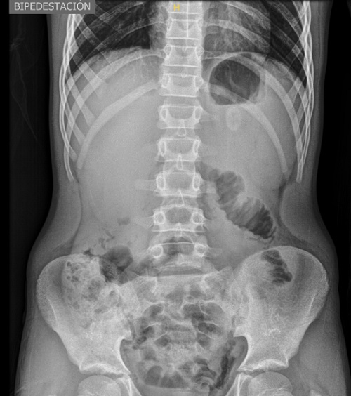 Figura 1. Radiografía de abdomen (cámara gástrica con contenido intraluminal y aire atrapado)