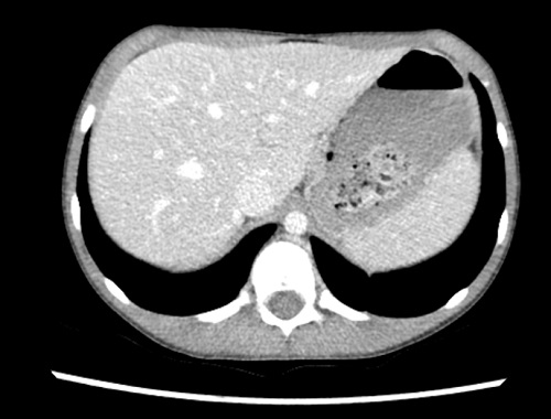 Figura 2. Tomografía computarizada de abdomen (cámara gástrica con contenido intraluminal heterogéneo y aire atrapado)