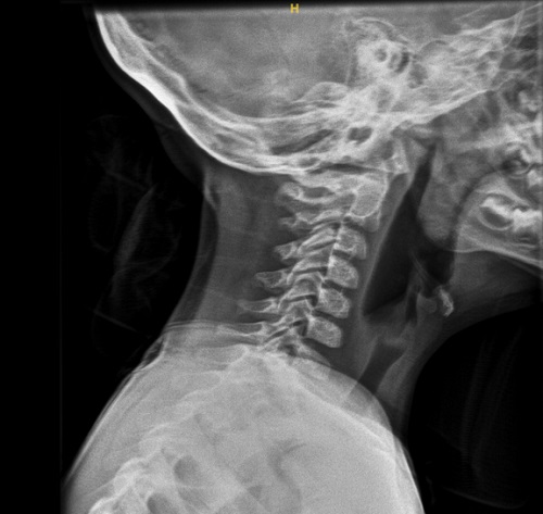 Figura 1. Tortícolis. Radiografía lateral cervical