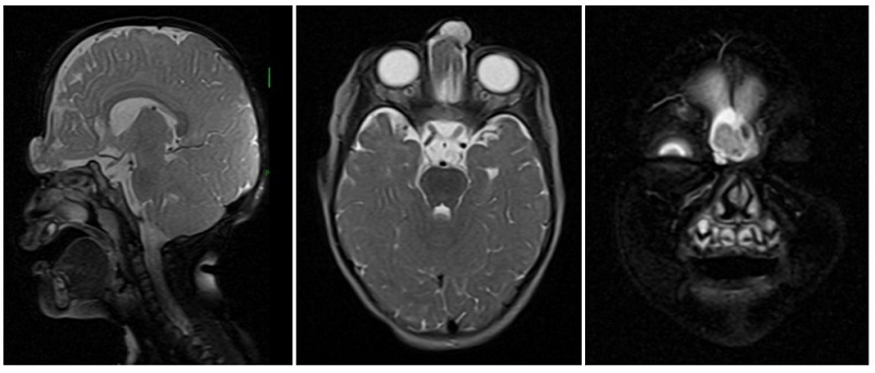 Figura 2. Encefalocele frontoetmoidal. Imágenes de RM cerebral potenciadas en T2 en los planos sagital, axial y coronal, en las que se observa un defecto óseo en la sutura nasofrontal. Herniación de meninges y ambos lóbulos frontales a través del defecto hacia los tejidos epicraneales, con formación de un encefalocele